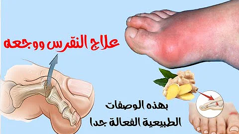 علاج النقرس نهائيا