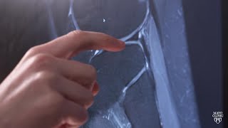 Mayo Clinic Orthopedics and Sports Medicine: Knee Meniscus