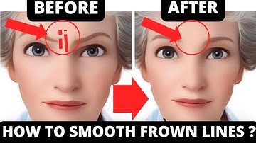 No Botox Needed: Effective Face Yoga for Wrinkles & Frown Lines