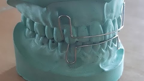Short Labial Bow Fabrication with Indications-Method 1 |Removable Orthodontic Appliance|Orthodontics