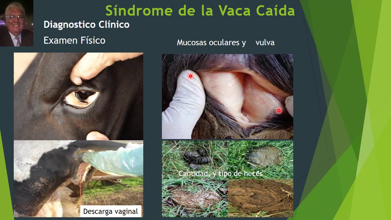 Síndrome de la Vaca Caída: Diagnóstico Parte 4