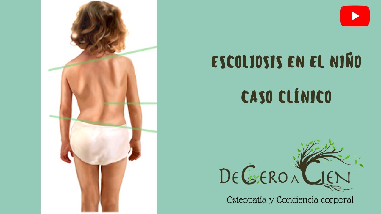 Escoliosis infantil, ¿por qué esperar para abordarla? Caso clínico