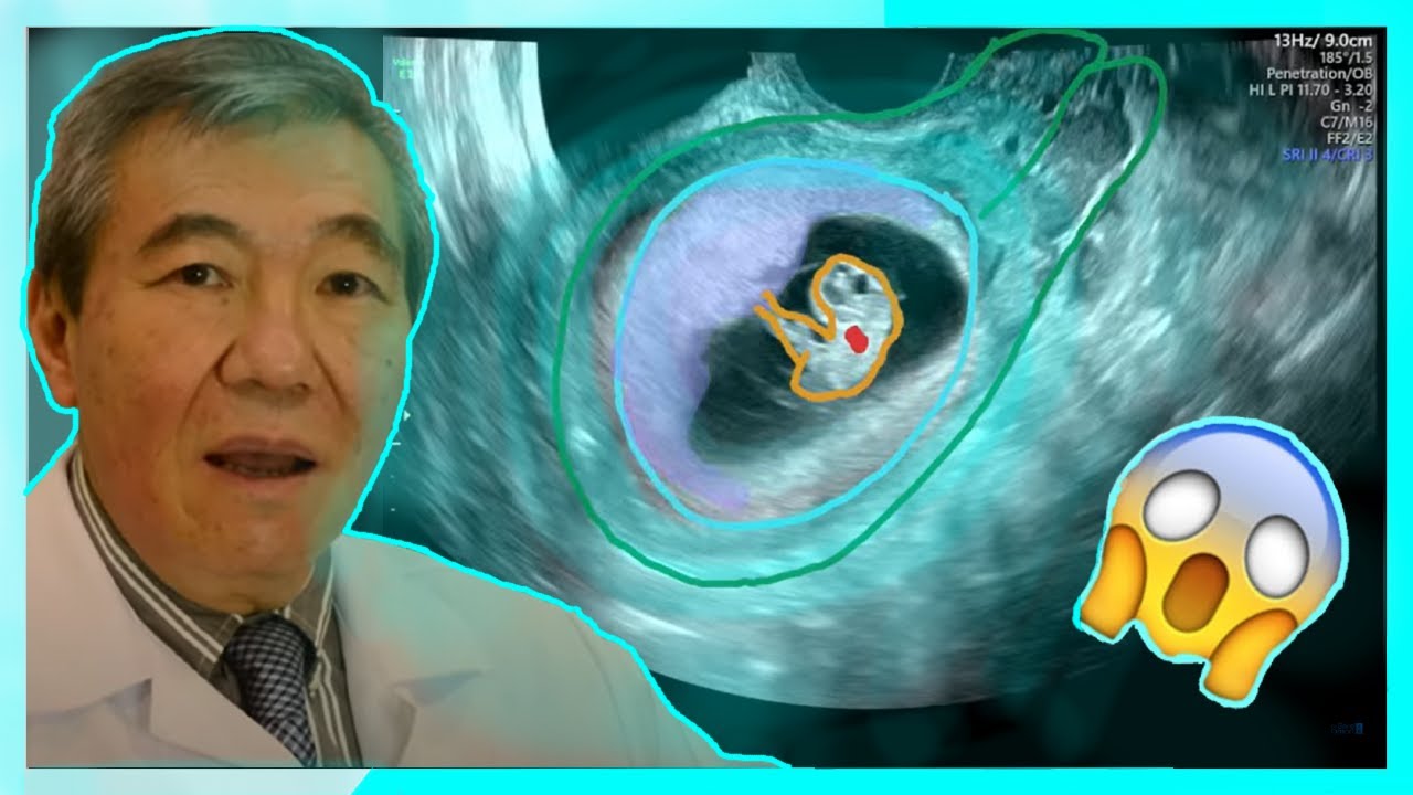 СЮРПРИЗ НА 1-М УЛЬТРАЗВУКЕ!