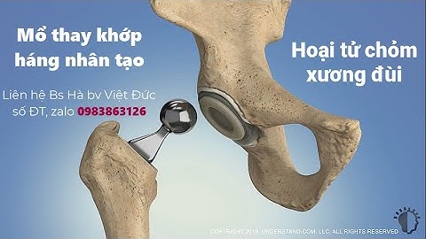 QUY TRÌNH PHẪU THUẬT THAY KHỚP HÁNG ĐIỀU TRỊ HOẠI TỬ TIÊU CHỎM XƯƠNG ĐÙI