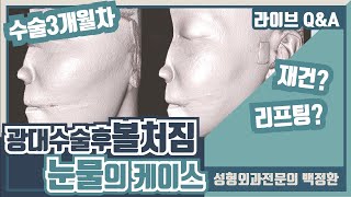 광대수술하고 볼처짐이 심해졌어요...어디가요?