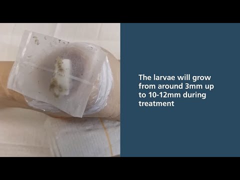 Larval Therapy application: using bagged larvae for wound debridement