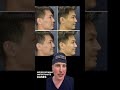 Male Rhinoplasty