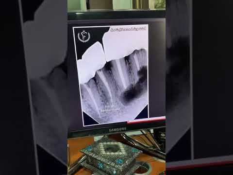 تابع أهم طبيب أسنان في سورية واجراء عملية قطع ذروة بدون ألم