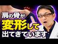 肩の骨の出っ張りが気になる方へ！原因は脱臼？変形？整形外科医が徹底解説