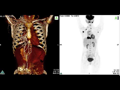 Video: Ako čítame Onkologické FDG PET / CT