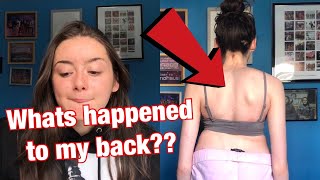 SCOLIOSIS / BACK UPDATE!!!!