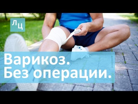 Как вылечить варикоз без операции. Склеротерапия в Лечебном центре.