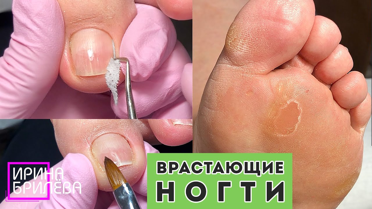 ПЕДИКЮР 🌸 Толстые ногти, склонные к врастанию 🌸 Треснувший ноготь и его ремонт 🌸 Ирина Брилёва