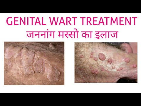 warts ka treatment in urdu)