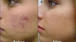 About Microdermabrasion | Before & After Acne Scars Blackheads PMD Facial  routine massage Skincare