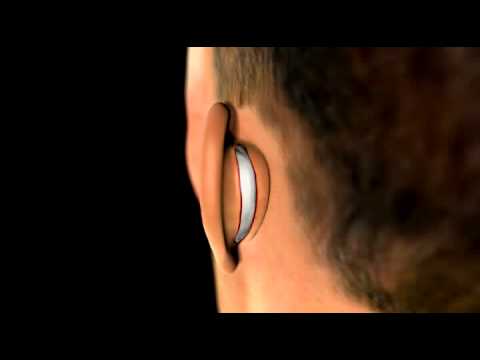 Ear Plastic Surgery - 3D Medical Animation || ABP © - YouTube