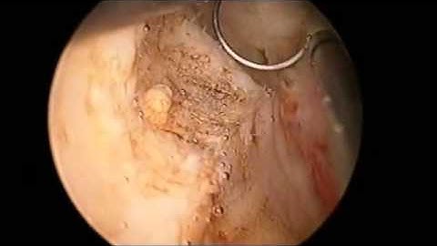 Cắt đốt nội soi lưỡng cực u tuyến tiền liệt