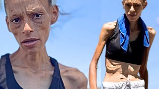 Jessica Is Skin & Bones. How Can We Help Her?