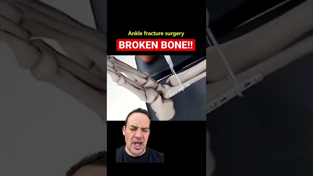 HOW TO FIX A BROKEN ANKLE!!😱 