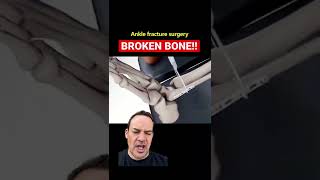 HOW TO FIX A BROKEN ANKLE!!😱 #shorts