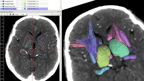 Brain CT image registration (spatial normalization) for DBS planning