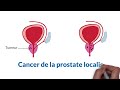 Comprendre le cancer de la prostate