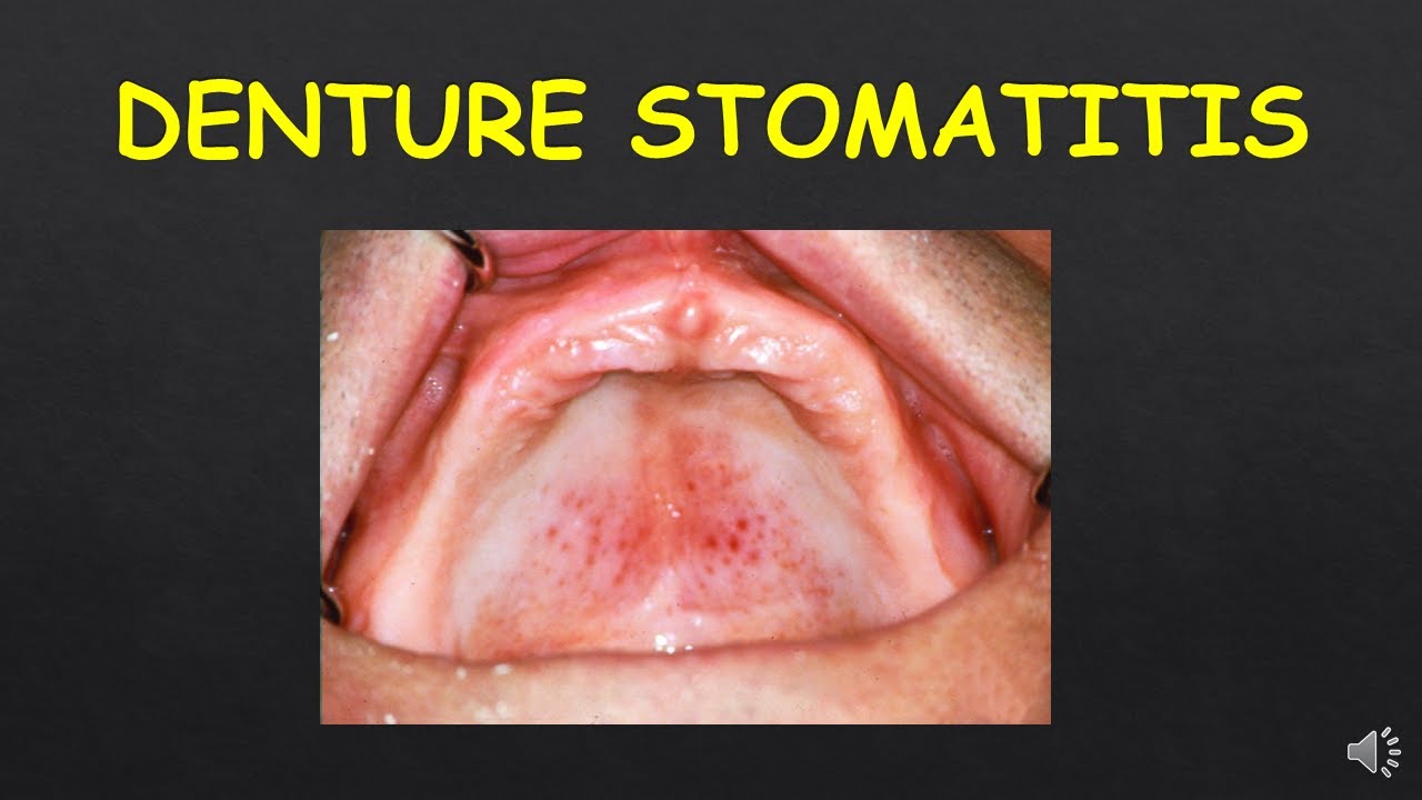 DENTURE STOMATITIS/ LECTURE SERIES/ EPISODE 10 YouTube
