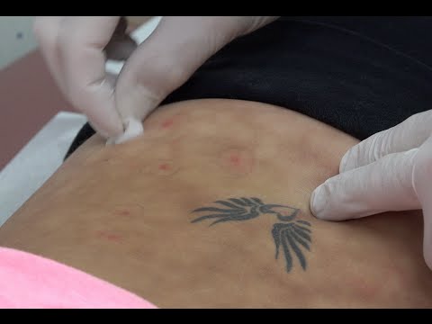 Trigger Point Injections For Shortstop, Toasted Skin Syndrome