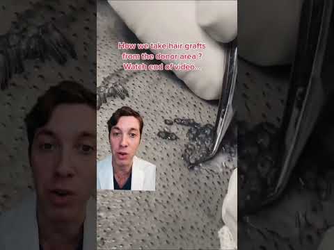 How An FUE Hair Transplant Is Performed
