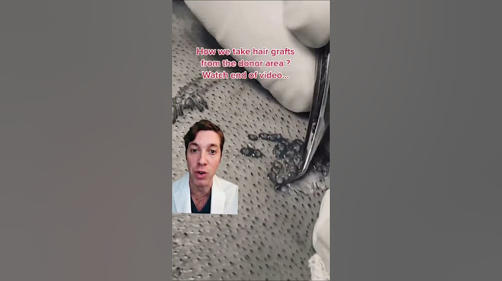 How an FUE Hair Transplant is Performed