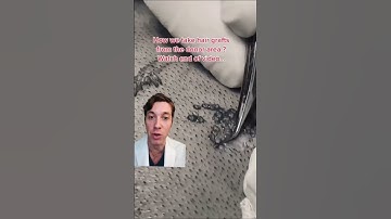 How an FUE Hair Transplant is Performed