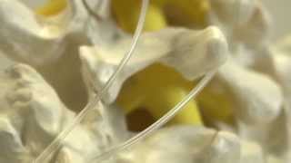 Spinal Cord Stimulator with Pain Specialist Dr. Donald Jones