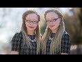 Twins With Albinism Wear Their Condition With Style | SHAKE MY BEAUTY