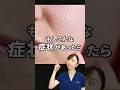 【もしこれがあったら】毛穴開きにおすすめの成分を解説