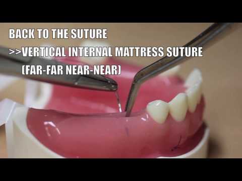 Back to the suture -8 Vertical internal mattress suture (FF NN)