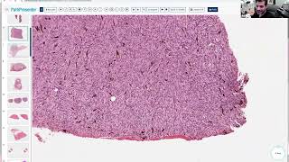 Avi Bitterman Dermpath Lecture 16 (Fibrous)