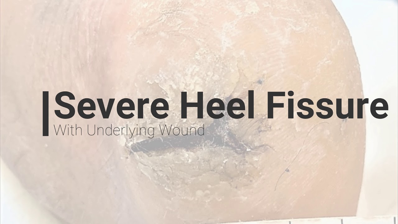 Cracked Skin in the Heel, DC Foot Doctor YouTube