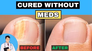 Cure Nail Fungus Without Medication