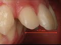 Tratamiento Ortodóncico de dientes adelantados sin extracciones  (Clase II esquelética)