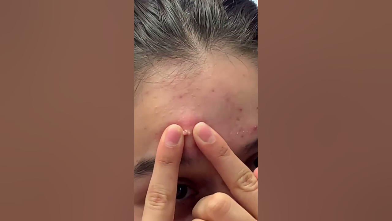 Big pimples sac dep spa Loan nguyen large blackheads YouTube