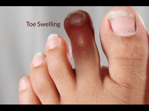Toes! Everthing you need to know!
