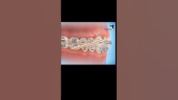 Damon Braces: How Self-Ligating Brackets Transform Orthodontics! #orthodontics#orthodontist #damon