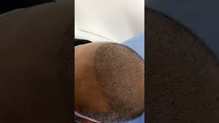 تقشير الشعر بعد 7 أيام من زراعة الشعر بإستخدام تقنية FUE وقلم سفير  |  افضل مركز زراعة الشعر في مصر