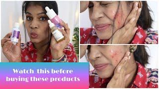 I tried chemical peels at home and this happened??!