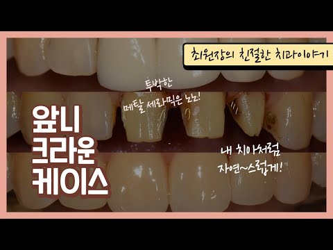 메탈세라믹 크라운을 올세라믹으로 치료