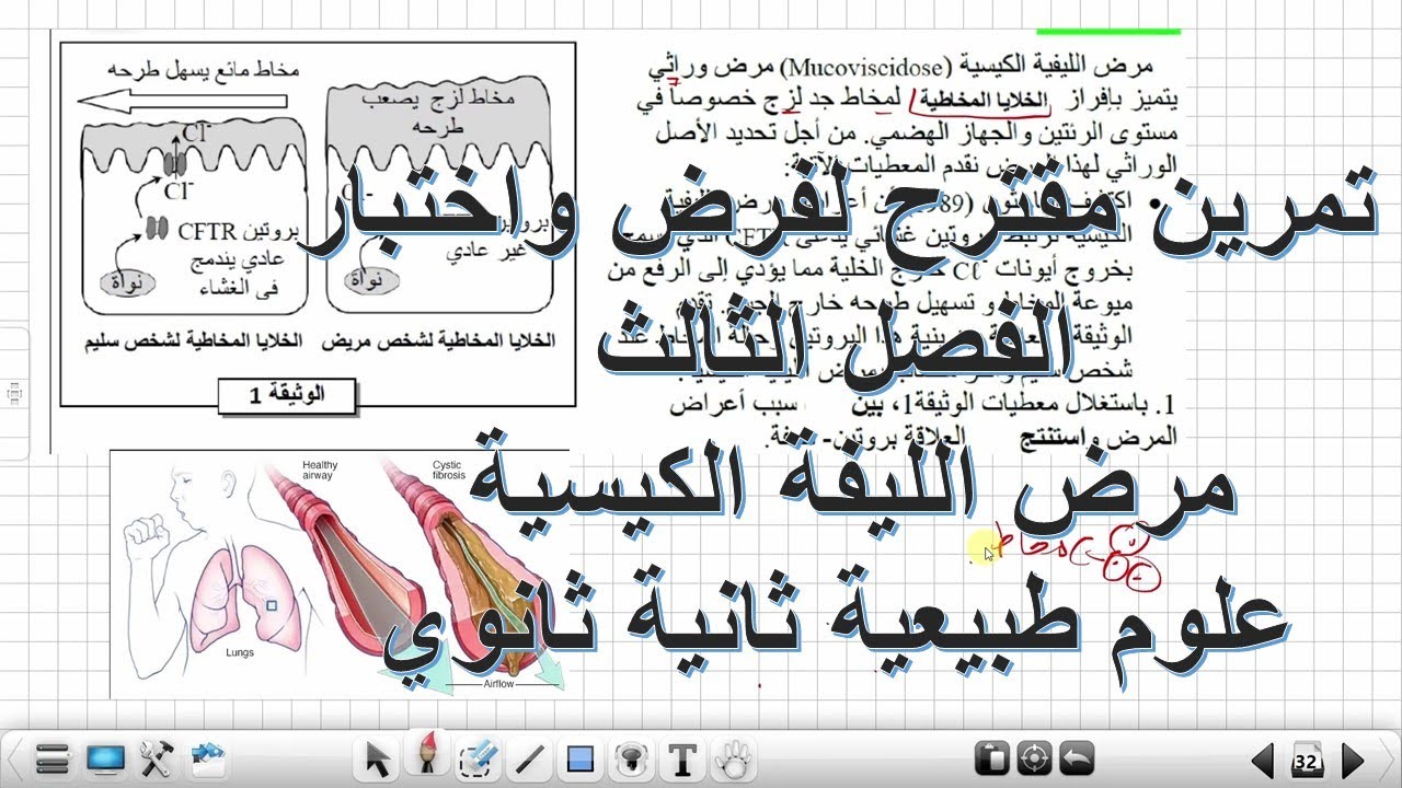 تمرين مقترح لفرض واختبارالفصل الثالث :مرض الليفة الكيسية علوم طبيعية السنة الثانية ثانوي