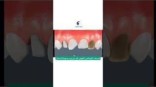 الفرق بين الدايركت فينير  و الايماكس فينير ؟؟؟ تابع الفيديو للنهايه لتعرف الفرق بينهما