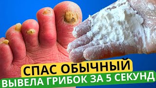 Nail Fungus Will Disappear FOREVER In 5 Seconds, This Method Will Help! Treating Nail Fungus EASY!