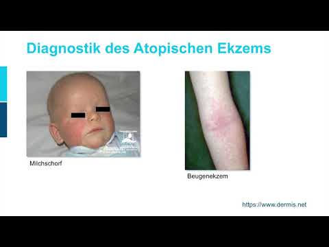 Video: Unterschied Zwischen Atopischer Dermatitis Und Ekzem