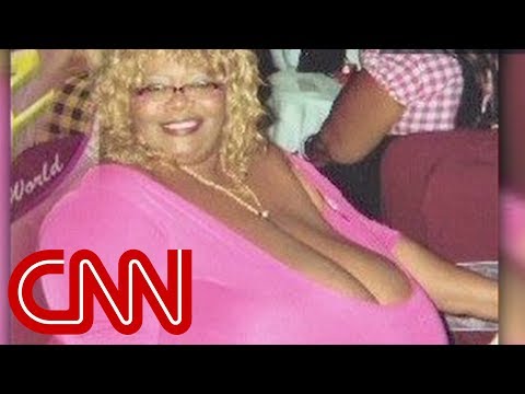 Annie Hawkins - the woman with the biggest natural breasts in the world 